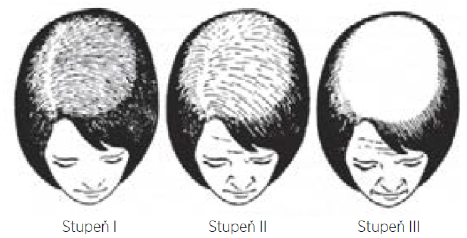 Klasifikace dle Ludwiga: