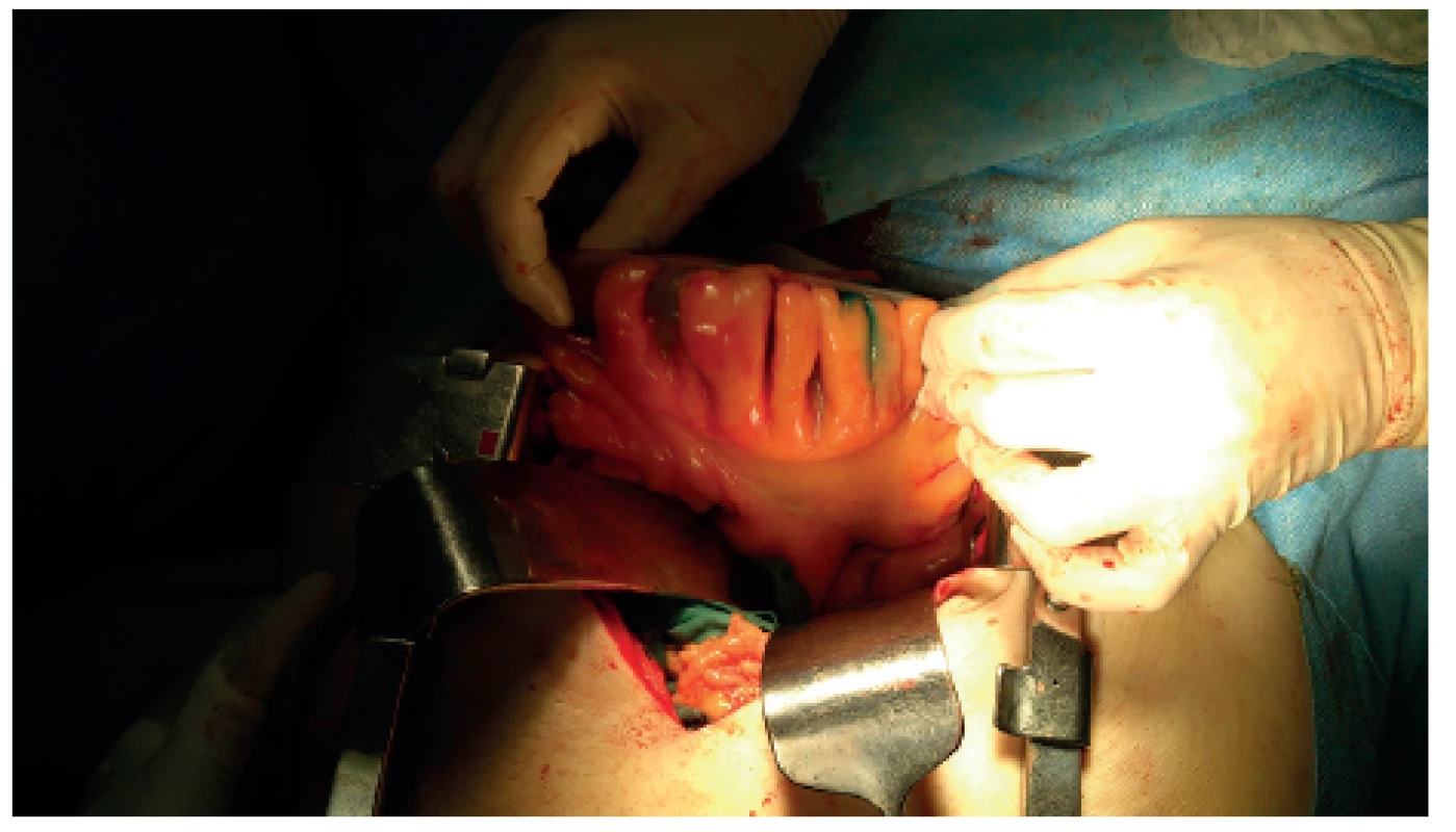 Distribuce barviva závěsem střeva
Fig. 2: Dye distribution in the mesocolon