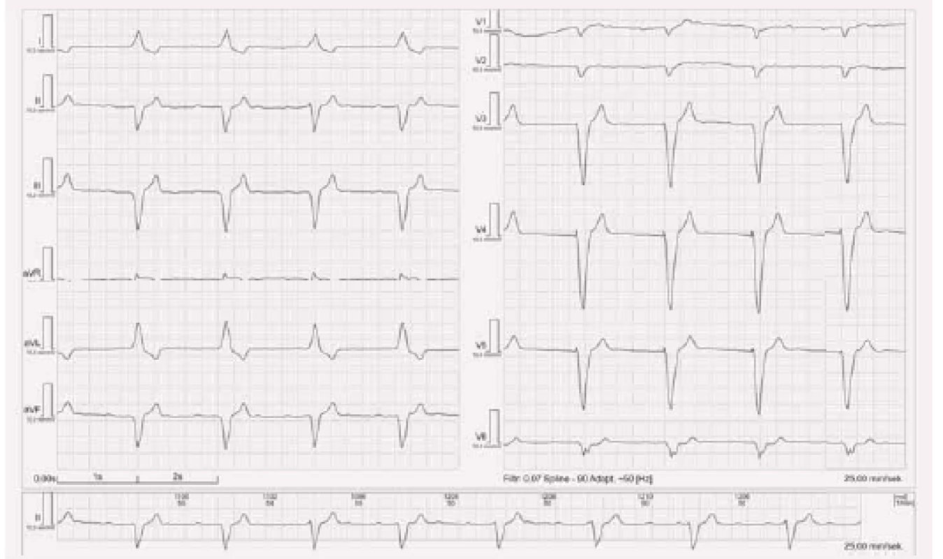 EKG stimulace z hrotu pravé komory bipolární.