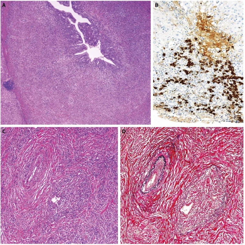 Sklerozující cholangitida asociovaná s IgG4. Zánětlivě fibroproduktivní změny s nápadným ztluštěním stěny žlučovodu. Barveno hematoxylinem eozinem (A, zvětšení 100x). Portální zánět bohatý na IgG4-pozitivní plazmocyty. IgG4 imunohistochemie (B, zvětšení 100x). Storiformní fibróza a obliterující endoflebitida (C, D). Barveno hematoxylinem eozinem (C, zvětšení 200x). Barveno dle van Giesona s elastikou (D, zvětšení 200x).