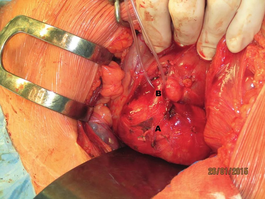 Laparotomie, transrektální řez v pravém podžebří (A – cysta ductus choledochus, B – distální choledochus)
Fig. 4: Laparotomy, transrectal incision in the right upper quadrant (A – choledochal cyst, B – distal bile duct)