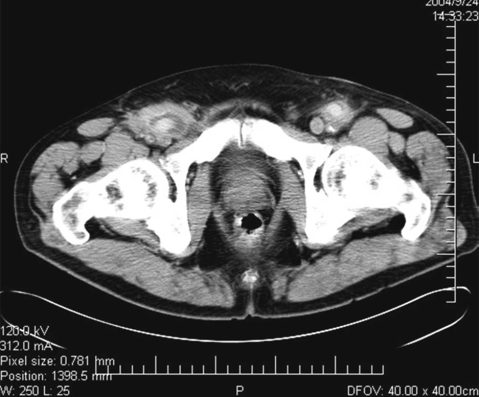 CT angiografie zobrazující infiltráty kolem cévních protéz v obou tříslech
Fig. 3. CT angiography showing bilateral periprosthetic infiltrates in the groin