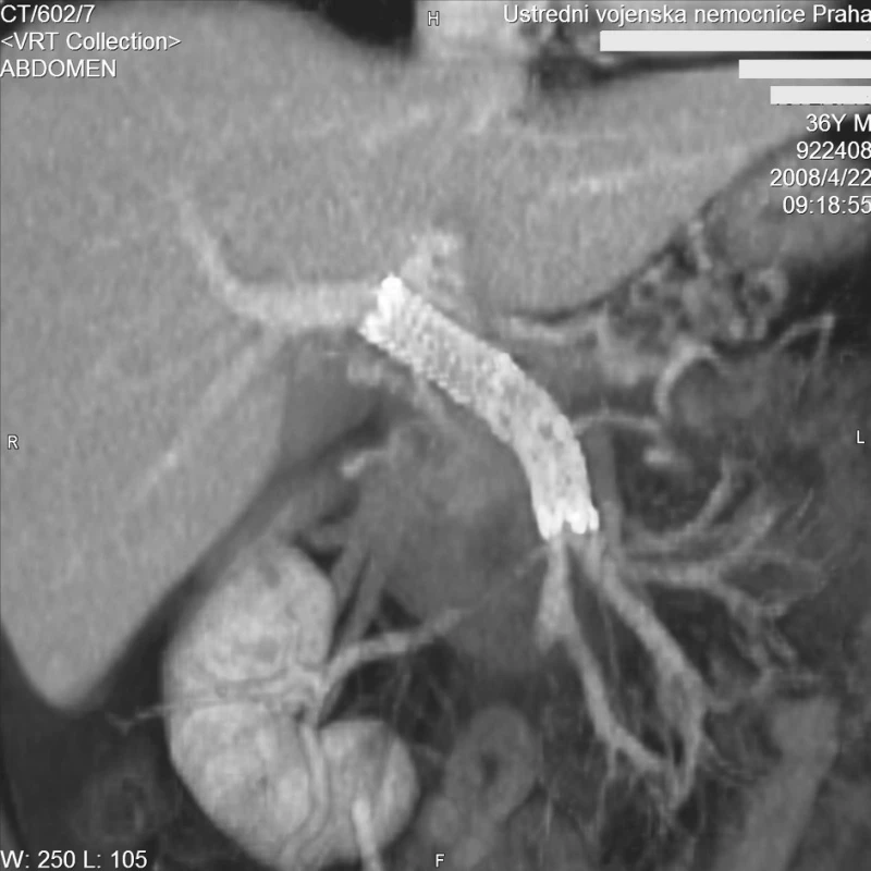 CT MIP rekonstrukce v koronární rovině. Kontrolní vyšetření za 6 měsíců. Stengraft je volně průchodný s normálním hepatopetálním tokem
Fig. 6. CT MIP reconstruction in the coronary plane. Control examination after 6 months. The stent is clear with normal hepatopetal flow