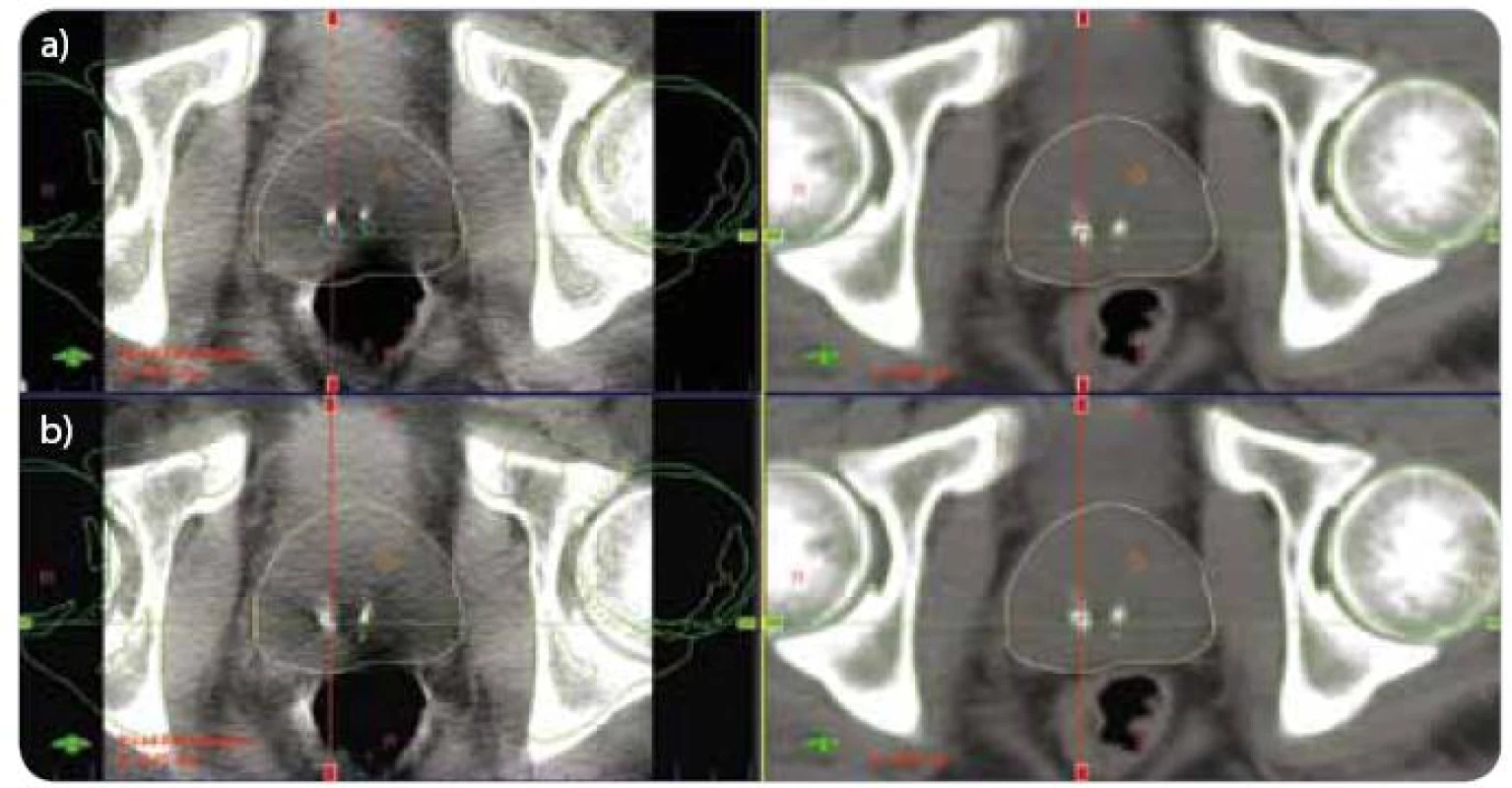 CBCT – registrace pozice skeletu pánve (a), registrace pozice prostaty (b).
(a) vlevo aktuální CBCT, vpravo refrenční plánovací CT
(b) vlevo aktuální CBCT, vpravo refrenční plánovací CT
CBCT – kilovoltážní CT kónickým svazkem