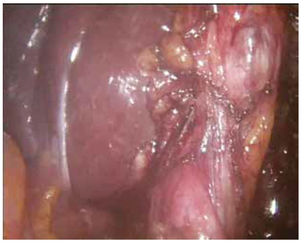 Hepatoduodenální ligamentum<br>
Fig. 3: Hepatoduodenal ligament