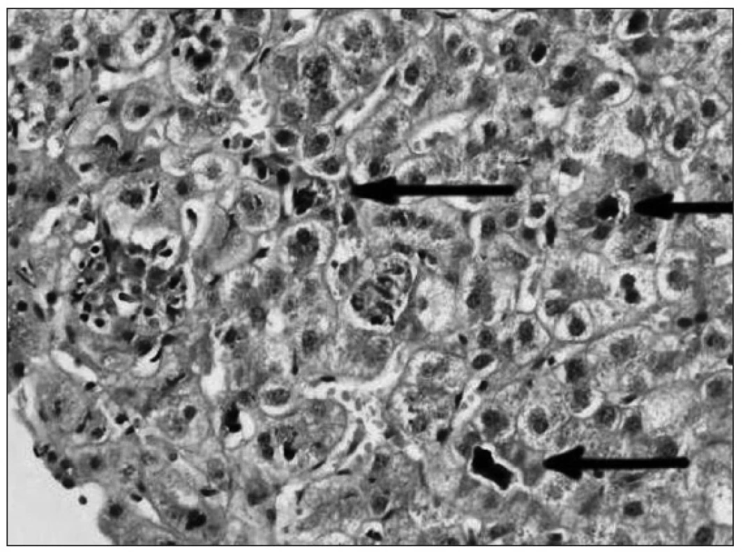 Cholestáza – akumulácia žlčového pigmentu v pečeni (HE, 40x).
Fig. 3. Cholestasis – accumulation of bile pigment in hepatocytes (HE, 40x).