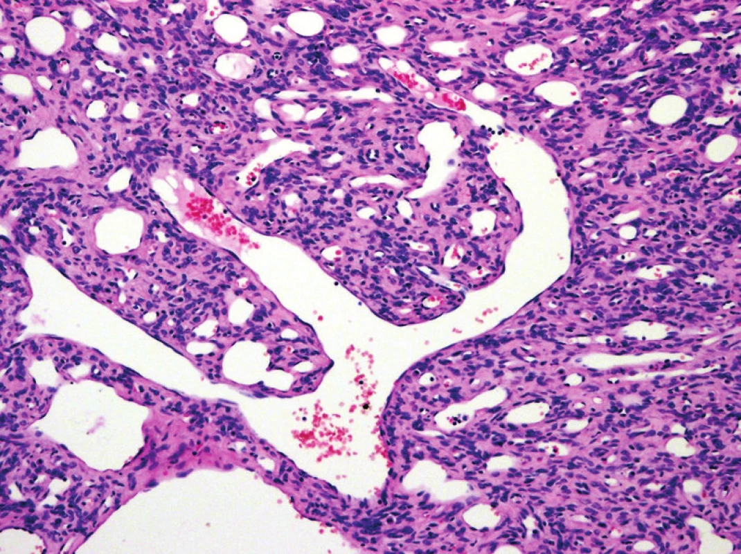 Solitární fibrózní tumor (SFT) s typickým parožnatým větvením cév. K extrapleurálnímu SFT byl v předchozí WHO klasifikaci řazen i hemangiopericytom. Tento termín byl z recentní klasifikace vypuštěn (původní zvětšení 100x).