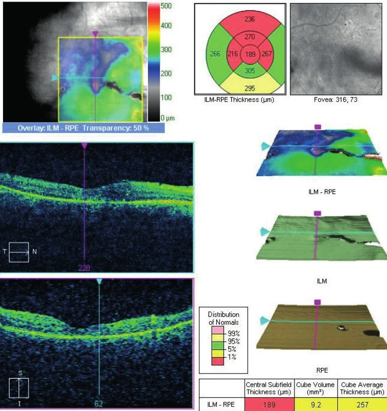 Vymizení otoku centrální krajiny po kombinované léčbě OZURDEXEM a ošetření sítnice laserem. Následné ztenčení neuroretiny v místě postižené sítnice prokazatelné na OCT (Cirrus, Zeiss)