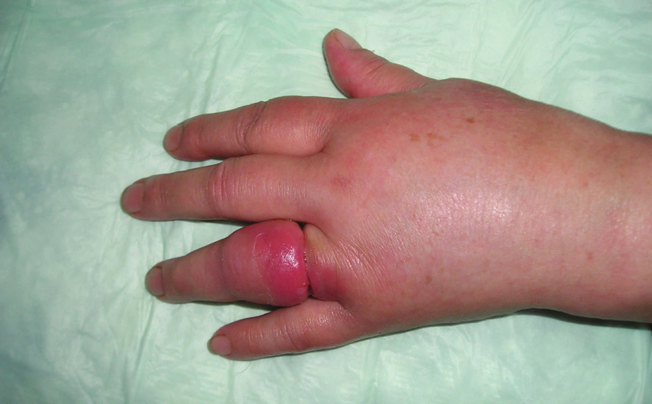 Pohľad na prst ihneď po odstránení prsteňa
Fig. 1. View of the finger immediately following removal of
the ring
