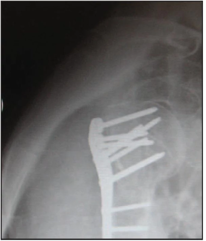 Osteosyntéza dlahou Phillos