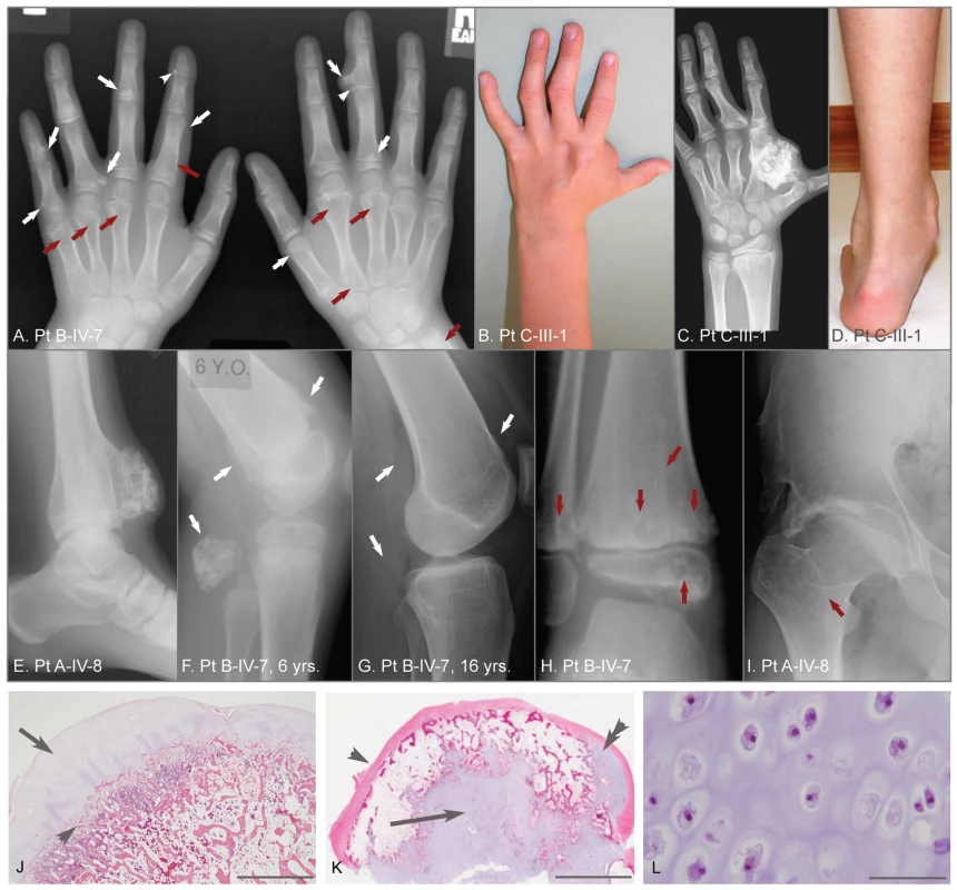 Clinical, radiographic, and histologic features of metachondromatosis.