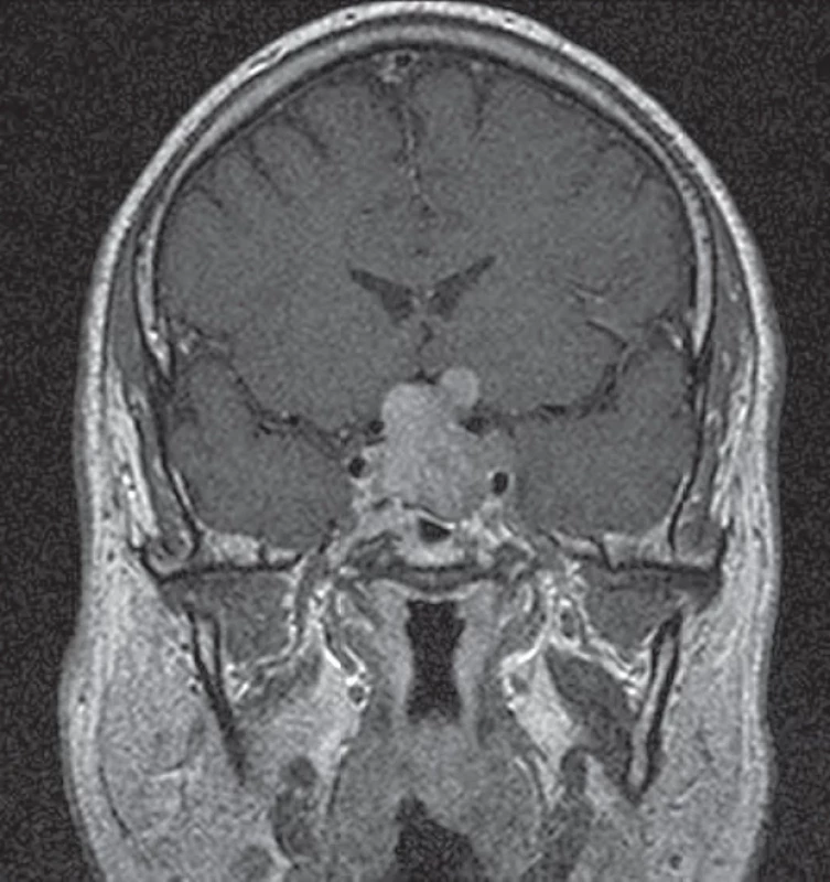 Makroadenom hypofýzy s výraznou suprasellární extenzí a tlakem na chiasma opticum. Fig. 1. Pituitary macroadenoma with marked suprasellar extension and pressure on the chiasma opticum.