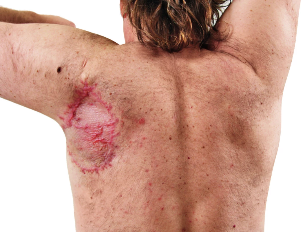 Patient 4 months after radical surgical procedure