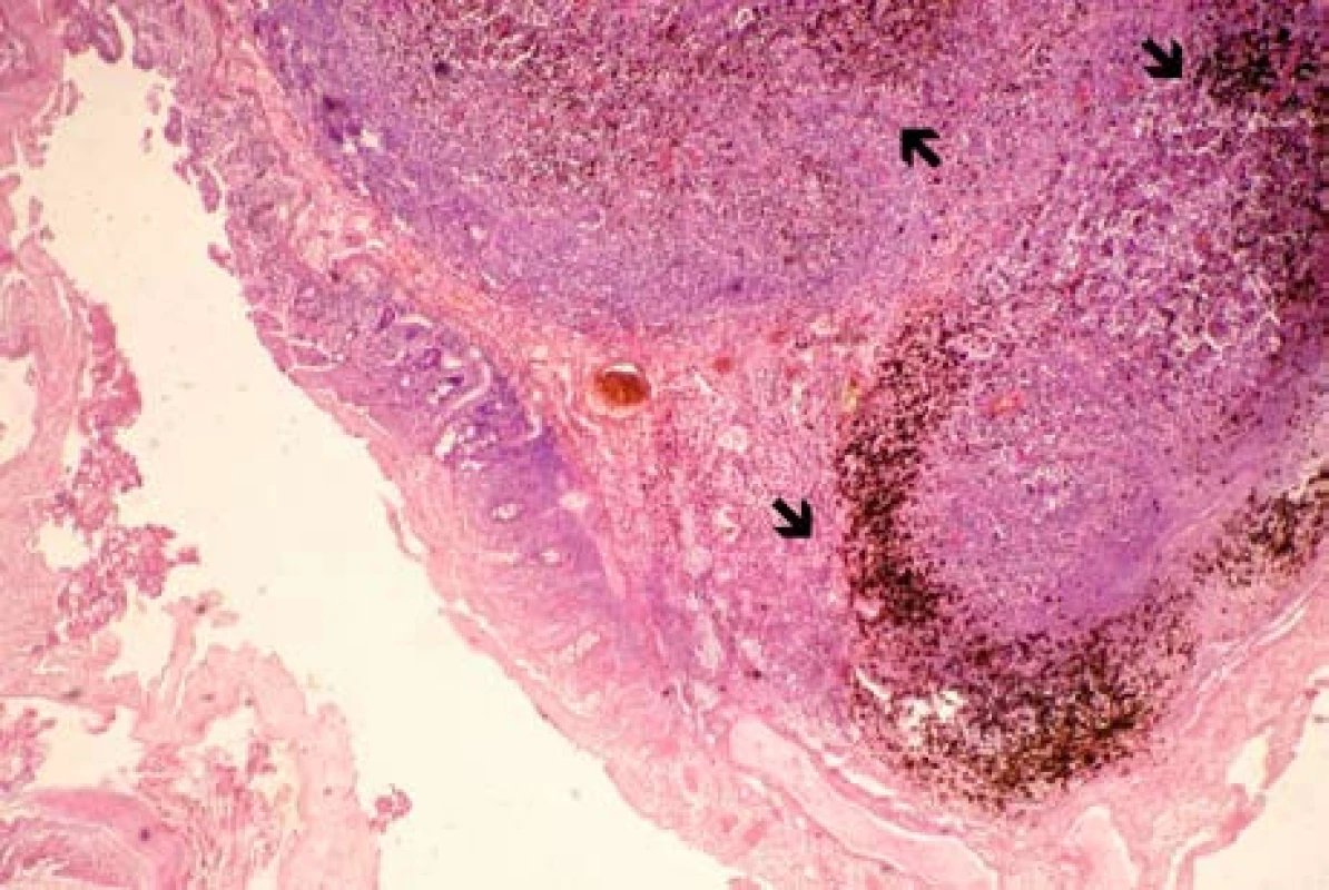 Melanotická metastáza maligního melanomu v bulbu duodena – šipky označují depozita melaninu (sekce, barvení hematoxylinem-eozinem, zvětšeno 40×).
Fig. 5. Melanotic metastasis of malignant melanoma of duodenal bulb – arrows indicate deposits of melanin (section, hematoxylin-eosin staining, enlarged 40×).