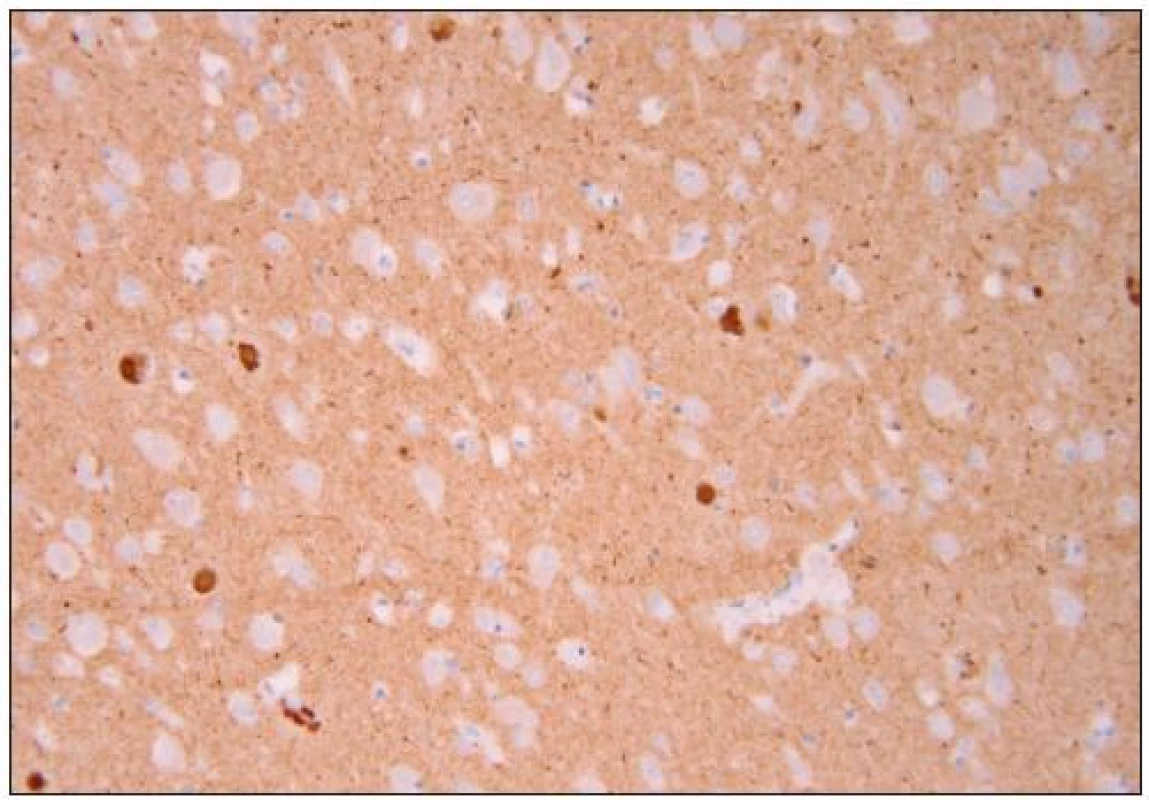 Lewyho tělíska u DLB [18]. 
Lewyho tělíska v hipokampální formaci pozitivní v imunohistochemické reakci s polyklonální protilátkou proti ubiquitinu u DLB.
