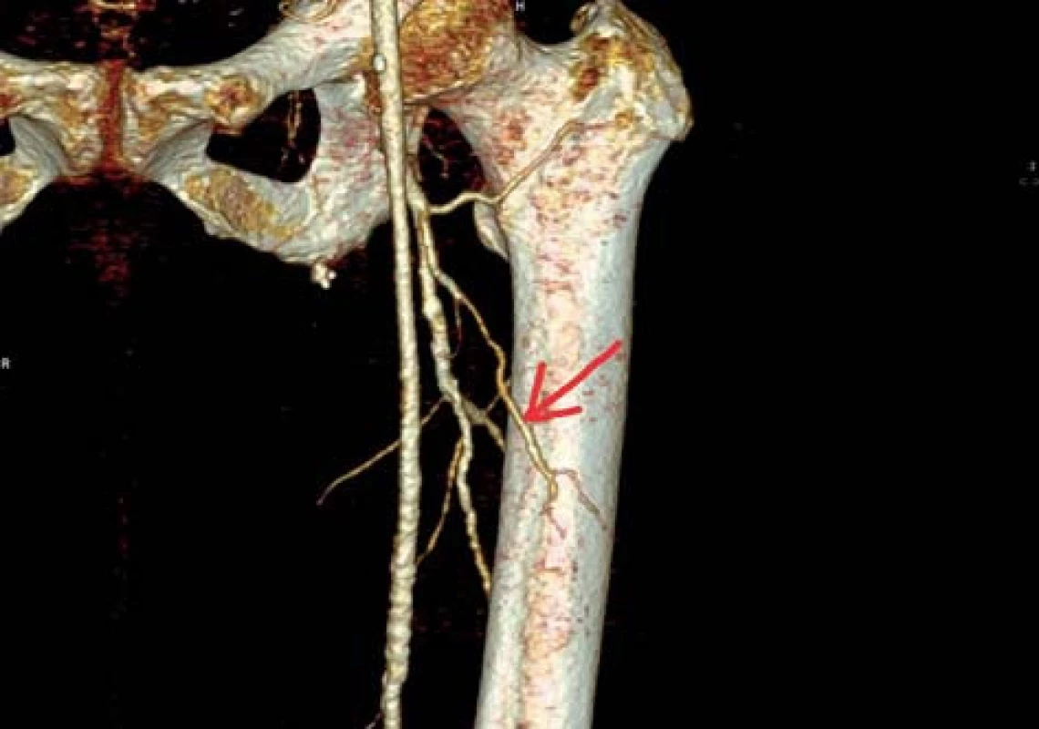 CT zobrazení RDACFL (označena šipkou)
Fig. 2: CT scan of DBLCFA (arrow)