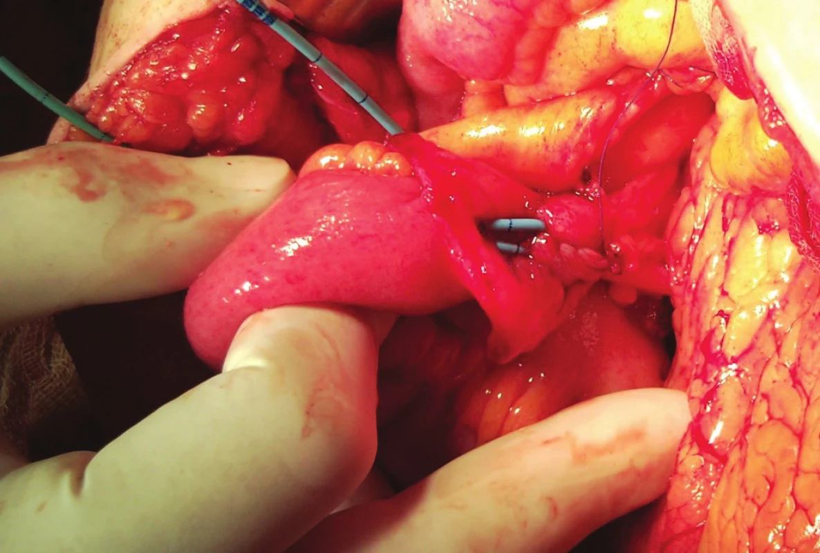Dvouhlavňová antirefluxní FT ureteroileální anastomóza do vrcholu ileálního konduitu – peroperační pohled.
Fig. 5: Double-barrelled FT anastomosis at the open end of ileal conduit – intraoperative view