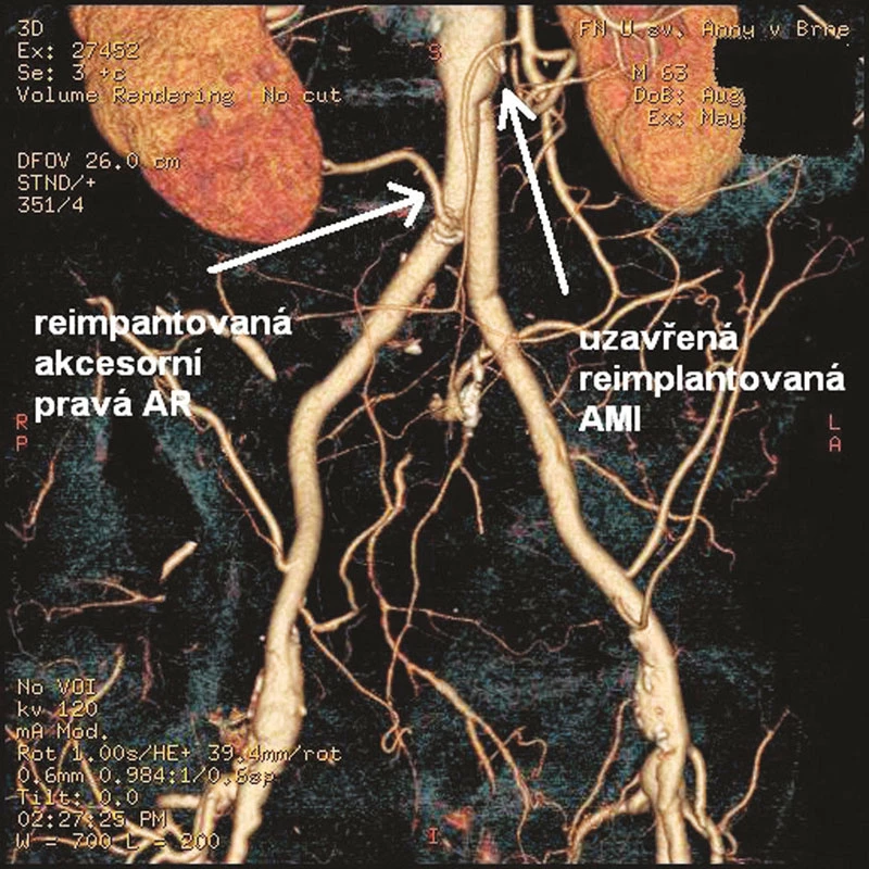 Pooperační rekonstrukce CTA s nálezem průchodné reimplantované akcesorní AR a uzavřené AMI
Fig. 3: Postoperative CTA with patent reimplanted accessory right renal artery (AR) and occluded reimplanted inferior mesenteric artery (AMI)