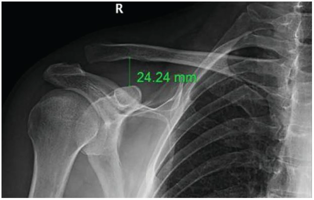 Dislokace typu Tossy III s C-C vzdáleností více než 2 cm
Fig. 1: Tossy III dislocation with C-C distance of more than 2 cm