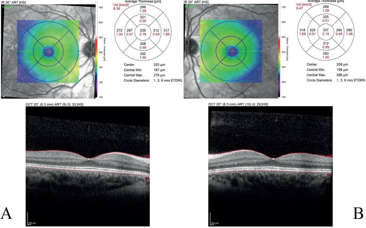 Follow-up OCT scans of the right (A) and left (B) eye performed one month postpartum. The OCT findings demonstrate complete resolution of subretinal and intraretinal fluid, with restoration of the foveal depression