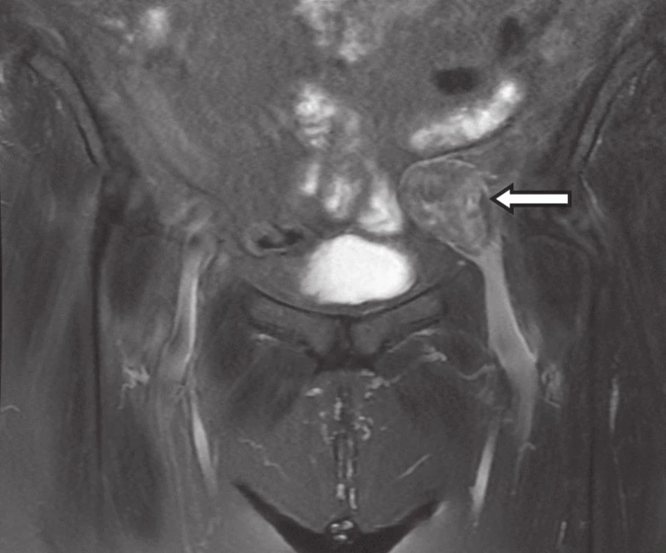 MRI − tumor vonkajšej panvovej žily
Fig. 1: MRI − tumor of external iliac vein