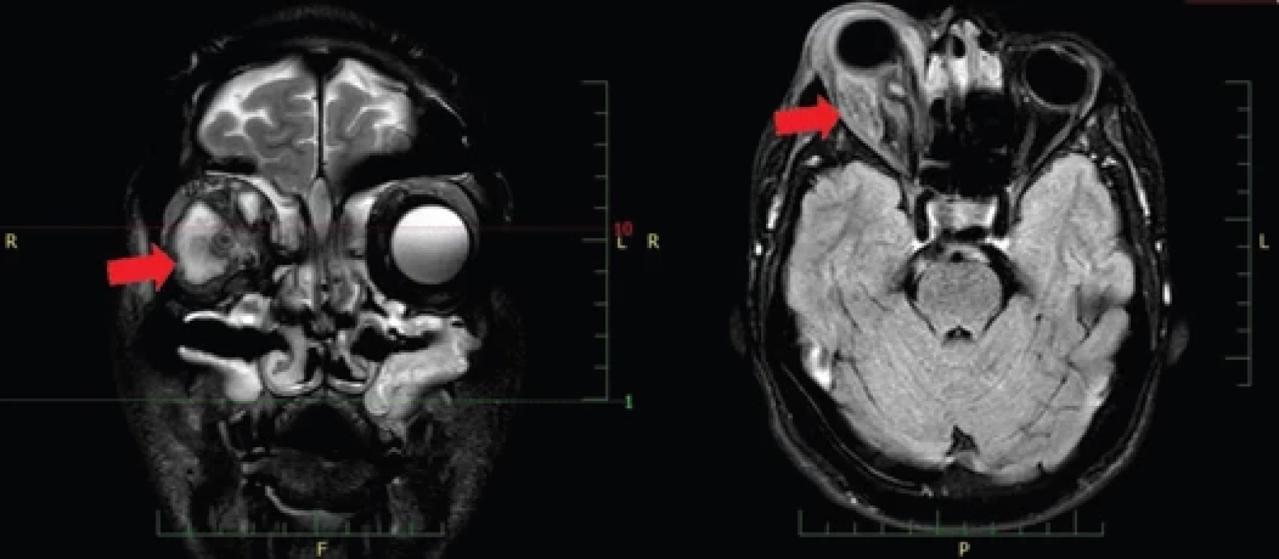 Doplňující MR, vlevo koronární projekce, vpravo axiální. Šipkami označena lokalizace abscesu v místě původního abscesu mediálně a absces očnice laterálně.