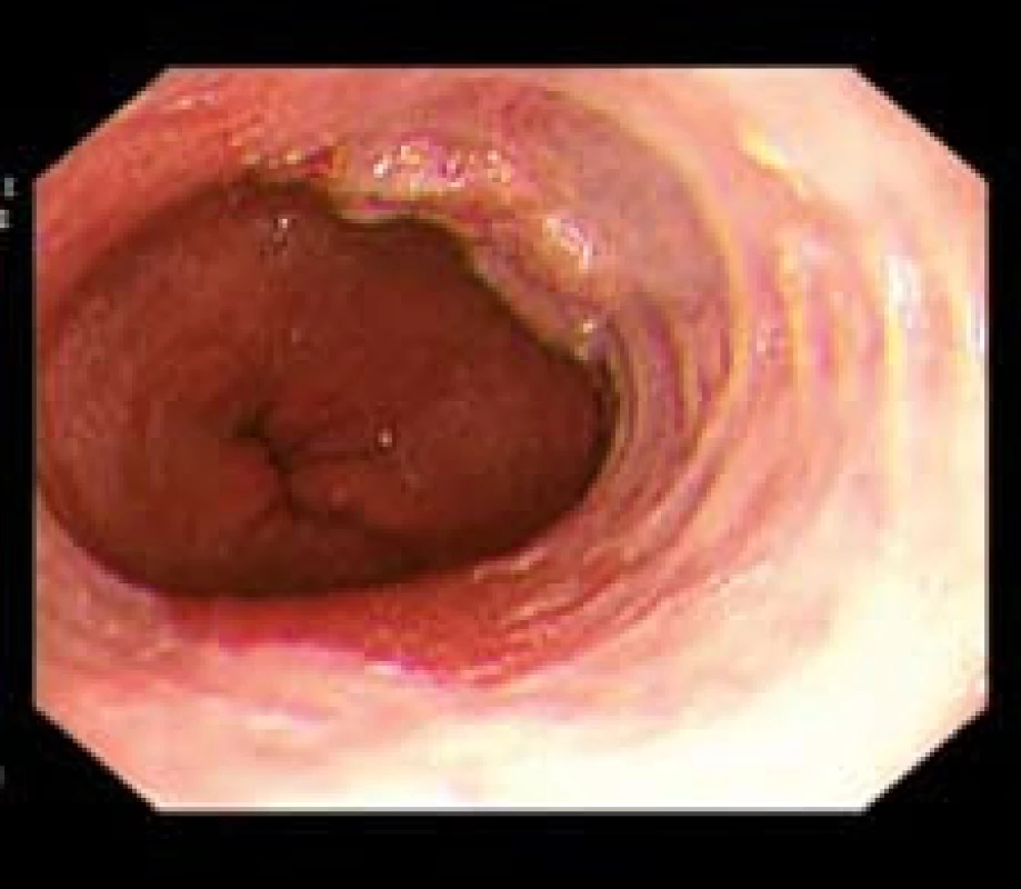Plochá léze 0-IIa dle Pařížské klasifikace – časný karcinom v terénu BJ.
Fig. 2. Flat lesion 0-IIa according Paris classification – early adenocarcinoma in BE.

