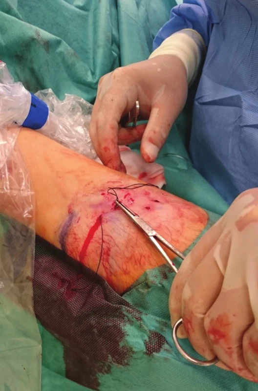 Pasáž jehly podkožím zpět nad žilou
Fig. 3: The needle crosses back over the vein in the subcutaneous tissue