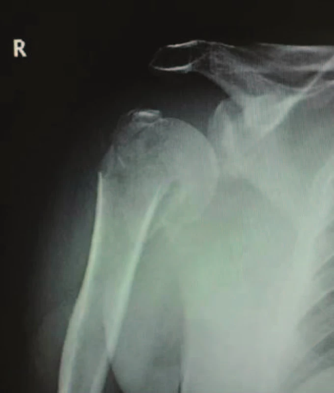 RTG obraz implantace PHILOS dlahy. Předoperační snímek