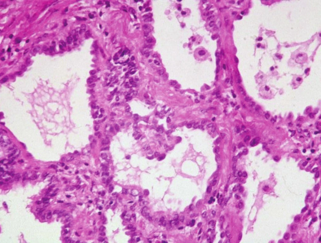 Změny ve smyslu intersticiální fibrózy po proběhlém difúzním alveolárním poškození. Převažují pneumocyty II. řádu, které mají vysokou regenerační schopnost. HE, 120krát