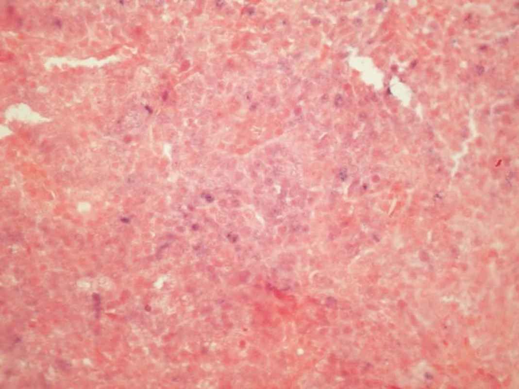<i>In situ hybridizace</i> (ISH - integrovaný typ barvení) u HNSCC s pruhy infiltrujícího dlaždicového karcinomu obsahujícími oblasti s granulární jadernou pozitivitou signálu modré barvy svědčící pro integraci DNA HPV do genomu buňky (INFORM HPV III Family 16 Probe, zvětšení 100x).