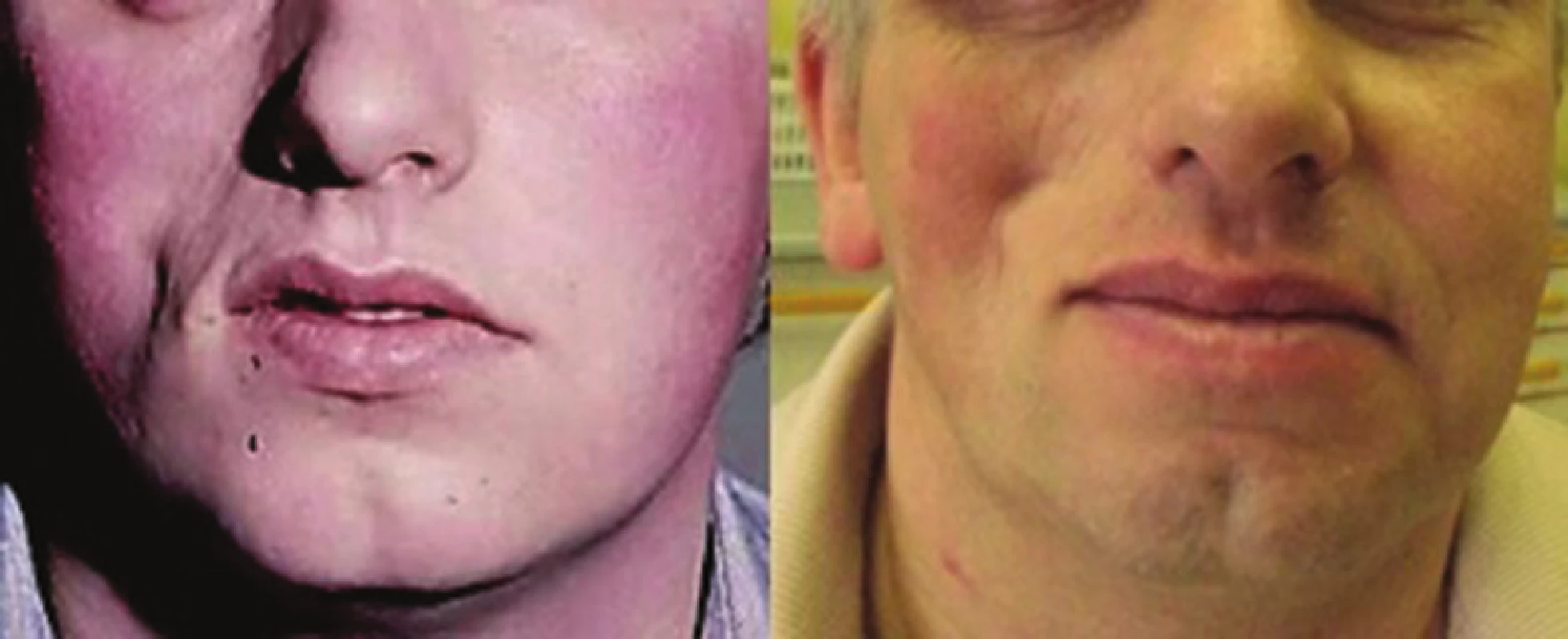 Progresivní faciální hemiatrofie