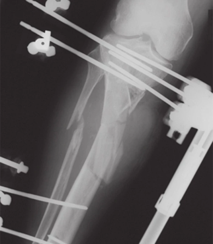 Temporérna fixácia zlomeniny pravej tíbie dvoma uniplanárnymi fixátormi
Fig.5: Provisional fixation of right tibial fracture with two uniplanar external fixators