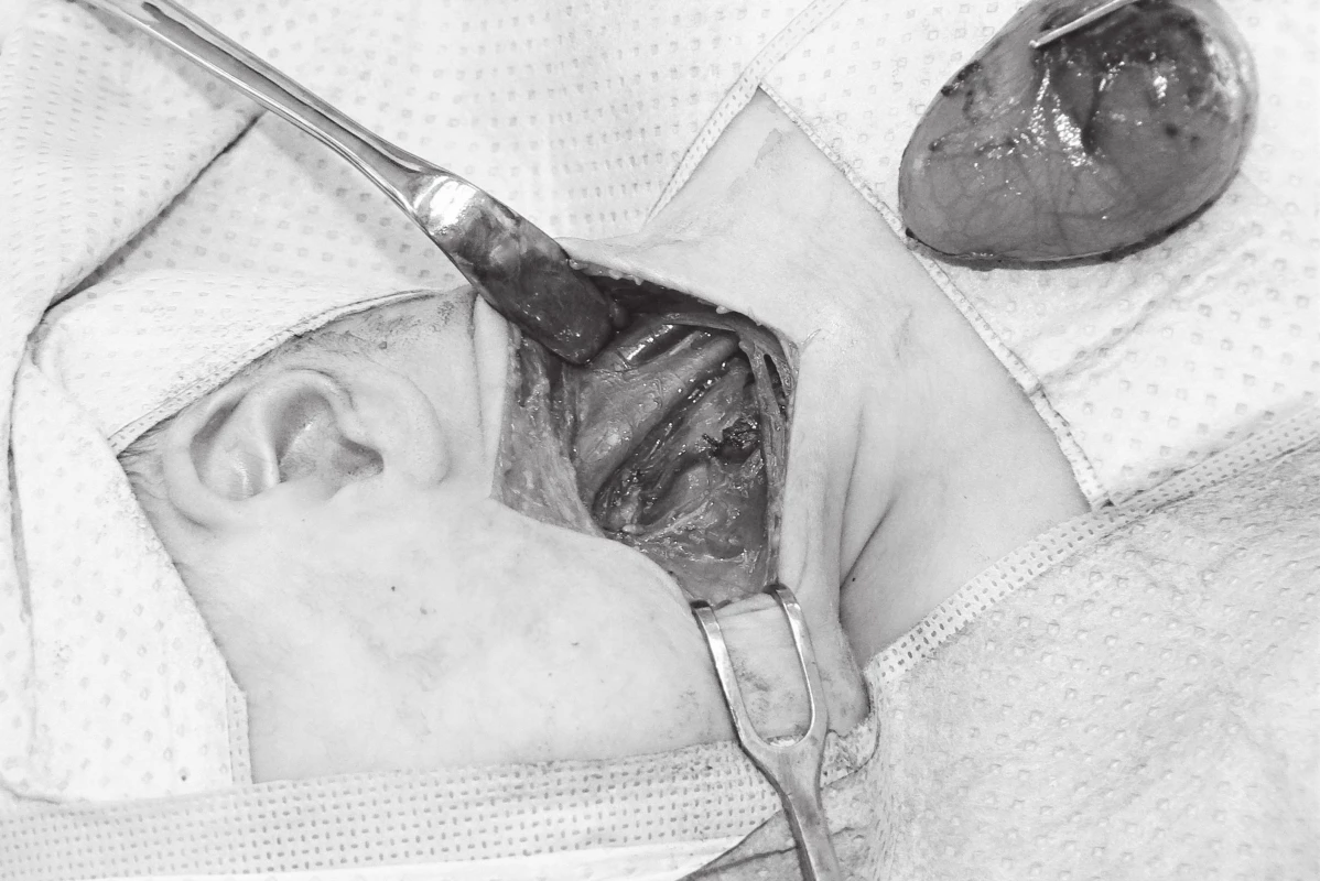 Operační pole po chirurgické exstirpaci cysty.
Fig. 2. Surgical extirpation of the cyst.