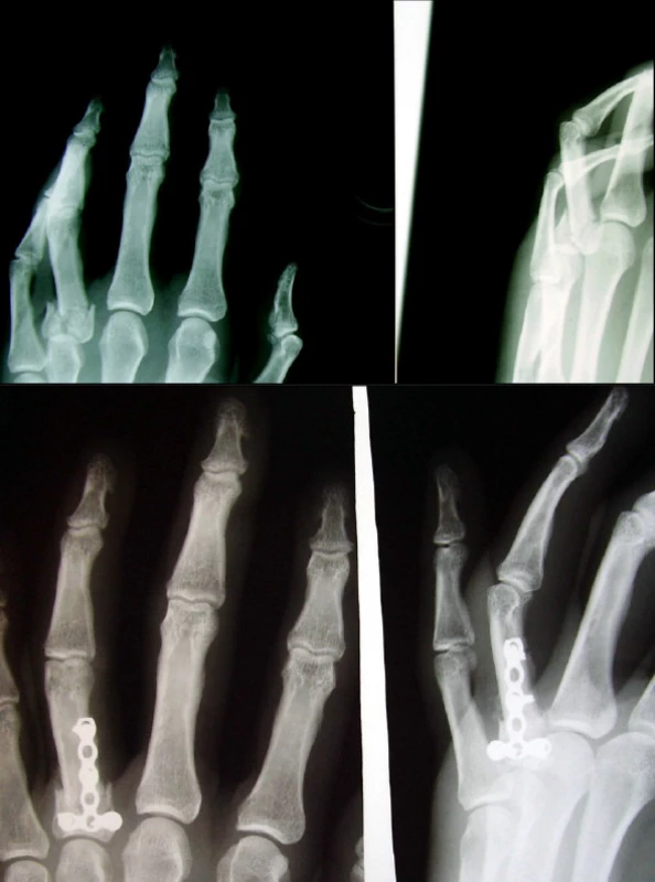 Intraartikulární zlomenina proximální epifýzy typu C (a) s dlahovou osteosyntézou (b)