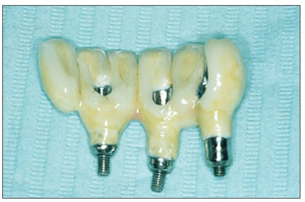 Cresco titan reconstruction: titanium framework grade 2 + Triceram ceramics