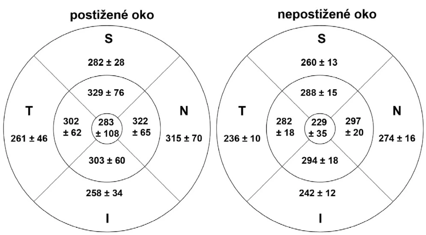 Tloušťka vrstvy nervových vláken v makule v akutní fázi AION v jednotlivých oblastech u postiženého a nepostiženého oka (S = superior = horní, I = inferior = dolní, N = nasal = nazální,T = temporal = temporální)
