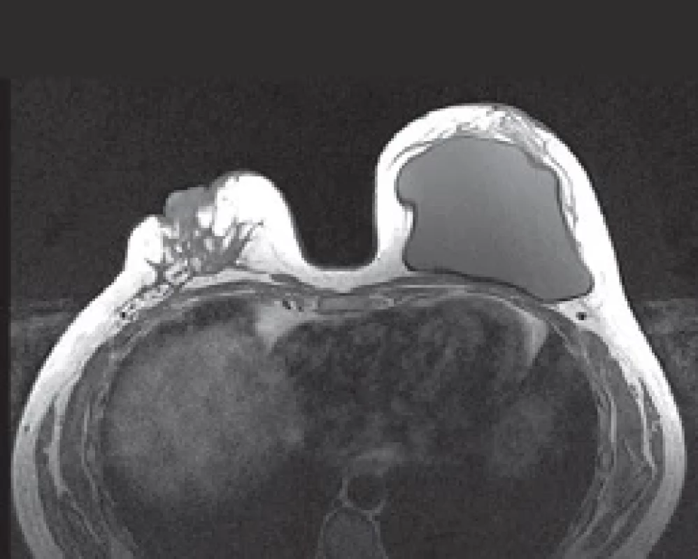 Magnetic resonance imaging. In the left breast, there is evidence of a prepectoral implant without signs of rupture, and in the right breast, there is heterogeneous fi broglandular tissue and nipple retraction.