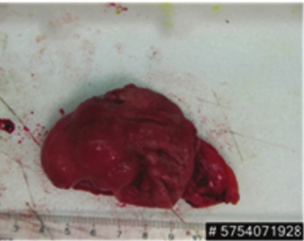 Resekát žaludku s GIST
Fig. 7: Gastric specimen with GIST
