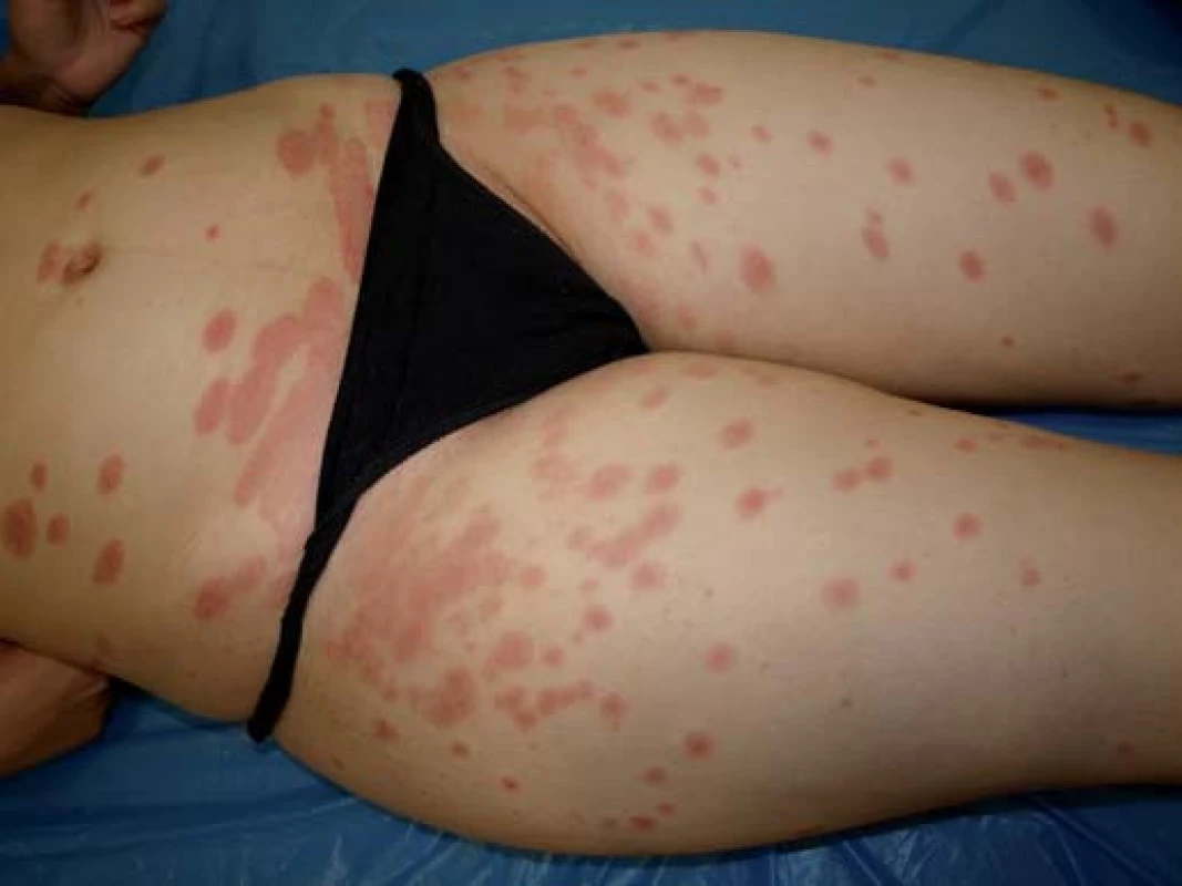 Recidiva psoriázy u nemocné při léčbě anti-TNF protilátkou.
Fig. 2. Recurrence of psoriasis in a patient on anti-TNF therapy.