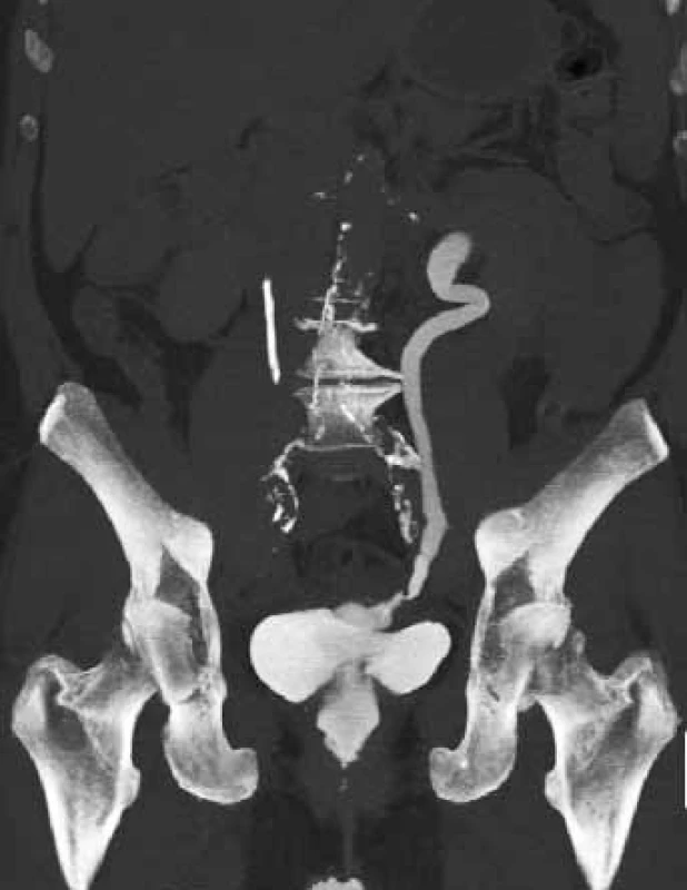 CT-IVU – ureterovaginální píštěl vlevo
Fig. 4. CT-IVU – ureterovaginal fistula on the left side