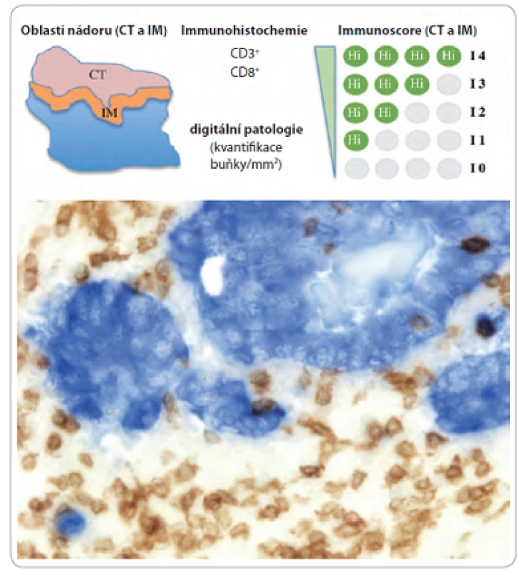 Definice a metodologie immunoscore (horní část); imunohistochemické barvení CD3<sup>+</sup> 
a CD8<sup>+</sup> buněk ve tkáni kolorektálního karcinomu (dolní část) [1].