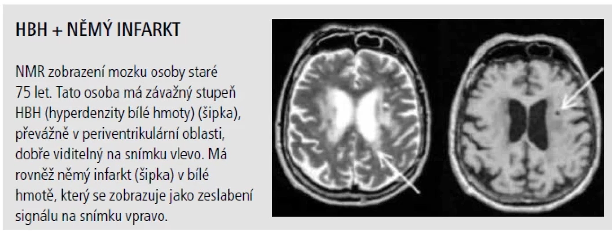 Subklinická orgánová poškození mozku (NMR zobrazení).