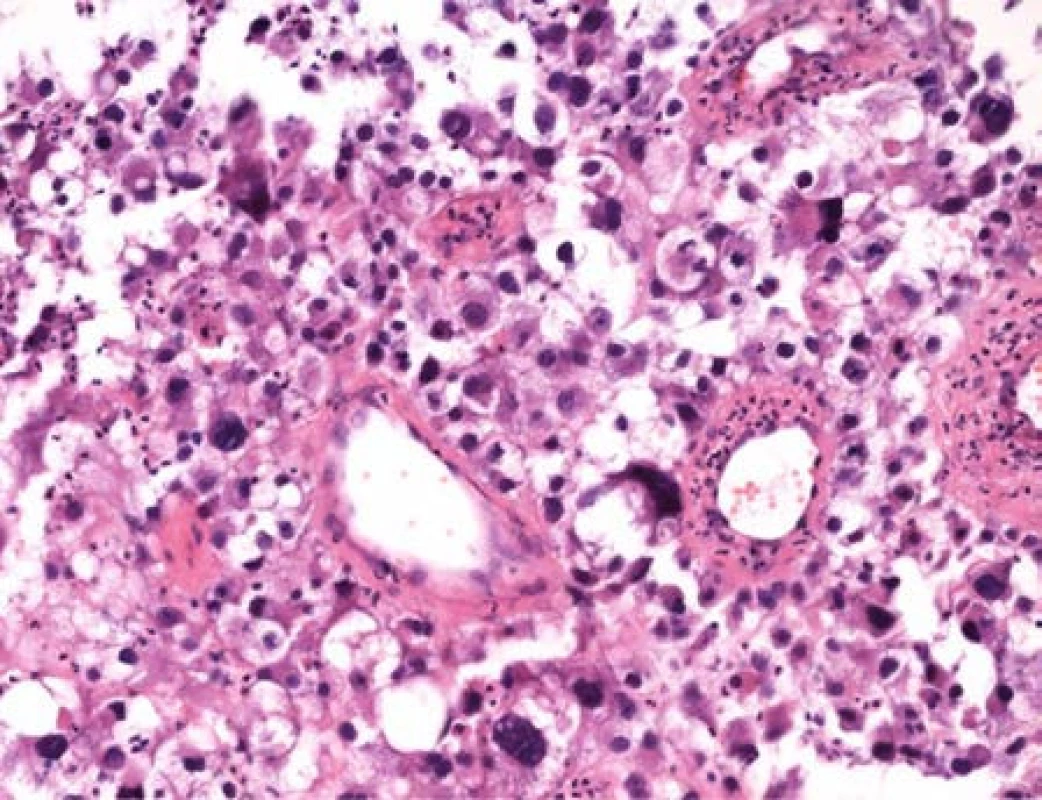Histologický preparát s nálezem atypických pleomorfních buněk s velkými jádry
Fig. 2. Histological specimen of pleomorphic cells with giant nuclei