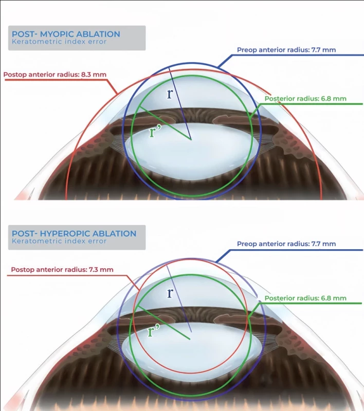 After myopic ablation, the anterior curvature is flattened (top), and, after hyperopic ablation (bottom), the anterior curvature is steepened, while the posterior one is unchanged in both instances. This causes the assumptions of the Keratometric Index to be invalidated