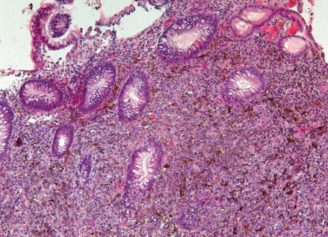 Histopatologický obraz sliznice tlustého střeva, infiltrované maligním melanomem, barvení hematoxylin-eozinem (zvětšení 100×).
Fig. 5. Histopathologic image of malignant melanoma infiltrating the colonic mucosa, hematoxylin and eosin stain (original magnification ×100).