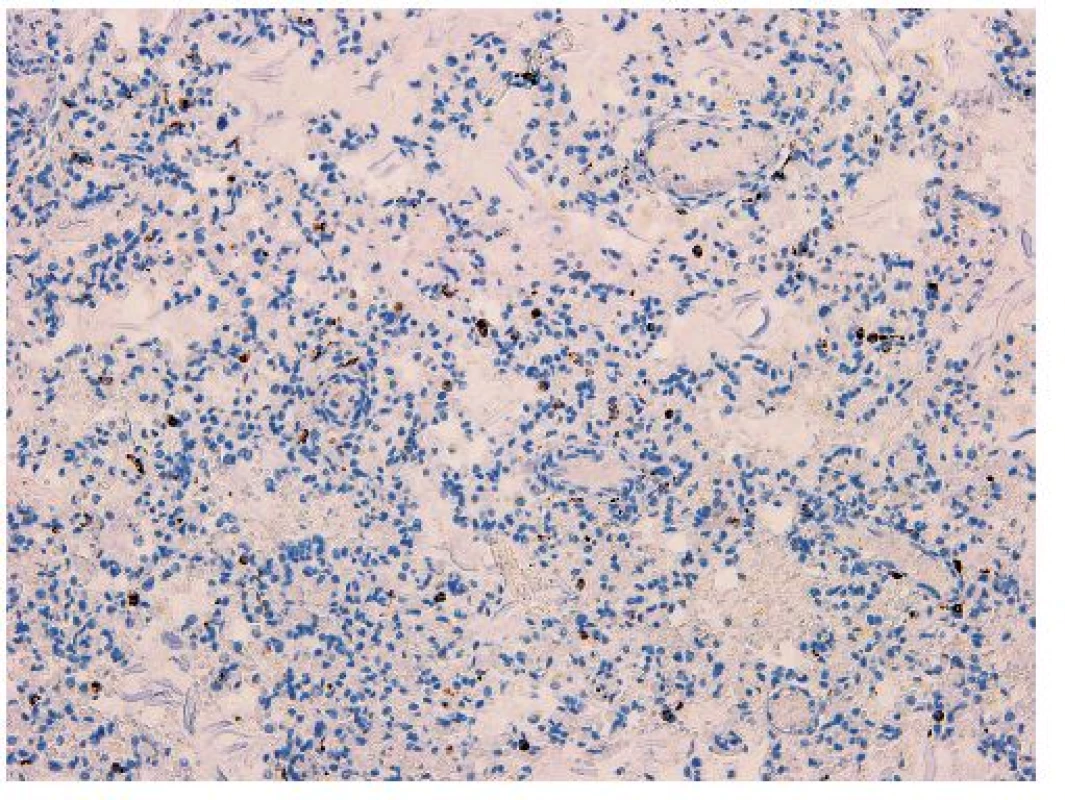 Imunohistochemický dôkaz CD68 v kontrolnej vzorke pľúc novorodenca takmer identického veku (imunohistochémia anti-CD68, zväčšenie 200x).