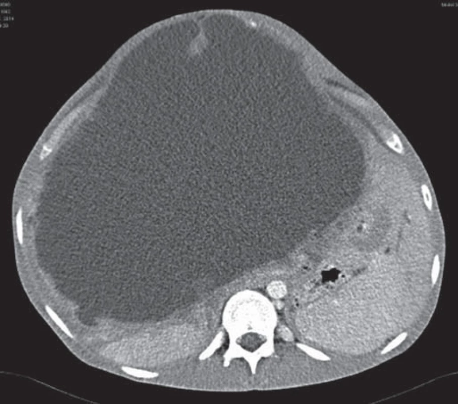 CT abdomenu pri recidíve v roku 2014 (viditená rozsiahla cystická lézia s vyklenovaním brušnej dutiny).
Fig. 1. CT of the abdomen during a relapse in 2014 (visible extensive cystic lesion with a domed abdomen).