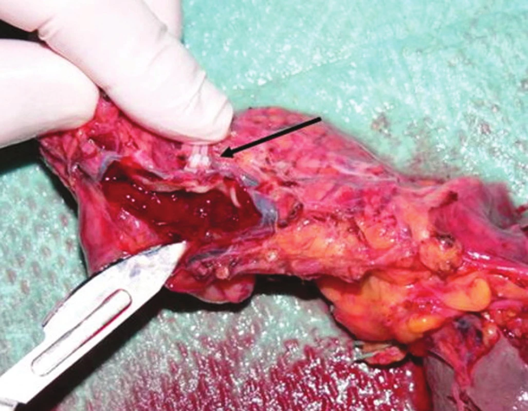 Červený trombus v pozdĺžne otvorenej a lienalis, biele klipy naložené na vena lienalis (šípka)
Fig. 3. Red thrombus in the longitudinally cut lienal artery, white clips placed on the lienal vein (arrow)