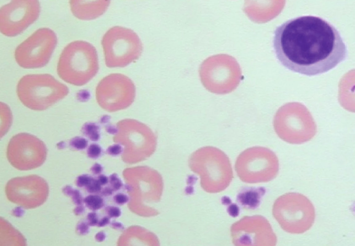 Pseudotrombocytopenie – velké shluky trombocytů v nátěru periferní krve odebrané do K3 EDTA (počet trombocytů odečtených analyzátorem – 4 x 109/l).
